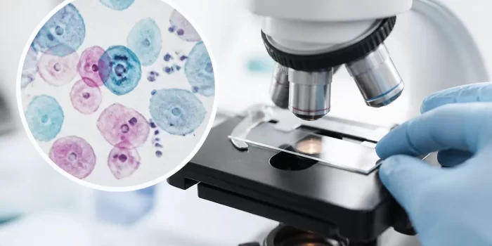 Ankstyvoji diagnostika gimdos kaklelio vėžio riziką sumažina iki 90%