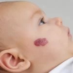 Hemangioma ant kūdikio odos