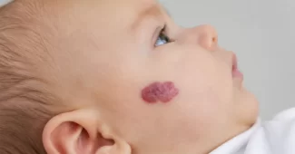 Hemangioma ant kūdikio odos