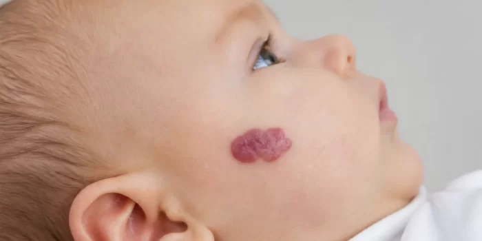 Hemangioma ant kūdikio odos