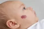 Hemangioma ant kūdikio odos