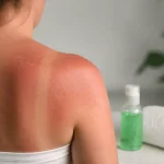 Nudegimas saulėje - ką daryti ir kaip apsisaugoti Nudegimas saulėje – ką daryti ir kaip apsisaugoti