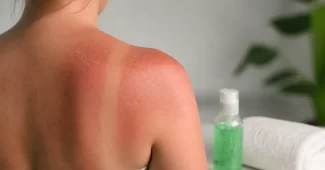 Nudegimas saulėje – ką daryti ir kaip apsisaugoti