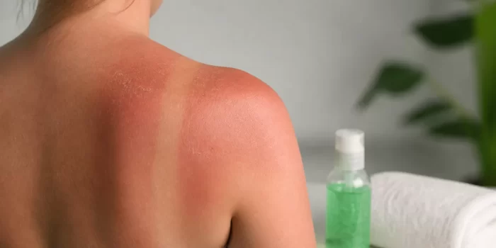 Nudegimas saulėje – ką daryti ir kaip apsisaugoti