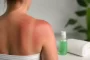 Nudegimas saulėje – ką daryti ir kaip apsisaugoti